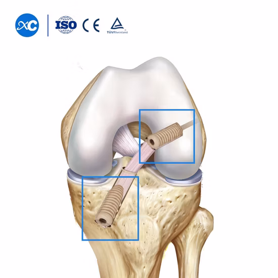 PEEK Suture Seƒoƒo ƒe Kplu (ACL/PCL) .