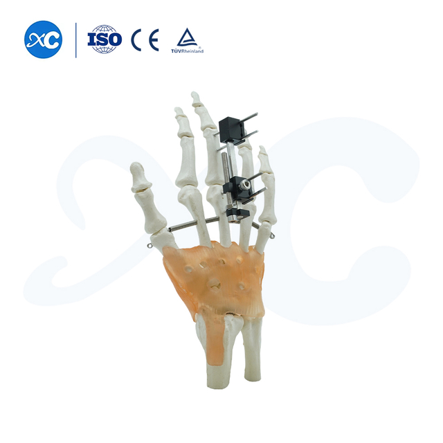 Fijación externa para metacarpales y falanges - comprar producto en XC Medico .