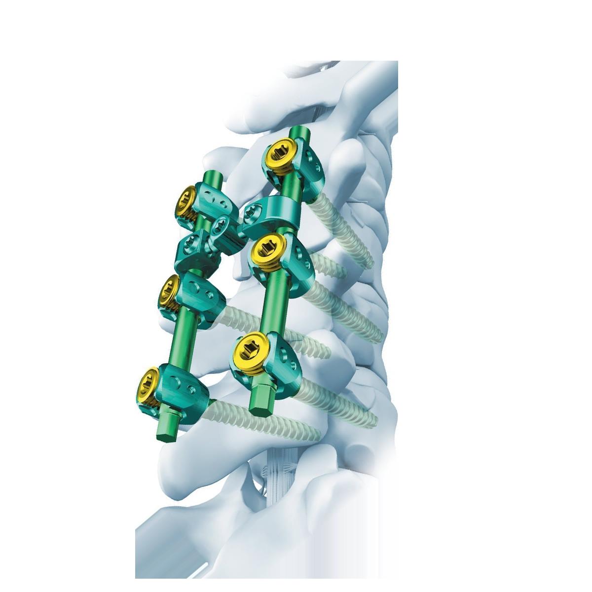 Kada reikalingas gimdos kaklelio stuburo suliejimas?