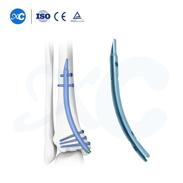 ದೂರದ ಟಿಬಿಯಲ್ ನೈಲ್ | ರೆಟ್ರೋಗ್ರೇಡ್ ಇಂಟ್ರಾಮೆಡುಲ್ಲರಿ ಫಿಕ್ಸೇಶನ್ ಸಿಸ್ಟಮ್ | XC ಮೆಡಿಕೊ ಆರ್ಥೋಪೆಡಿಕ್ಸ್