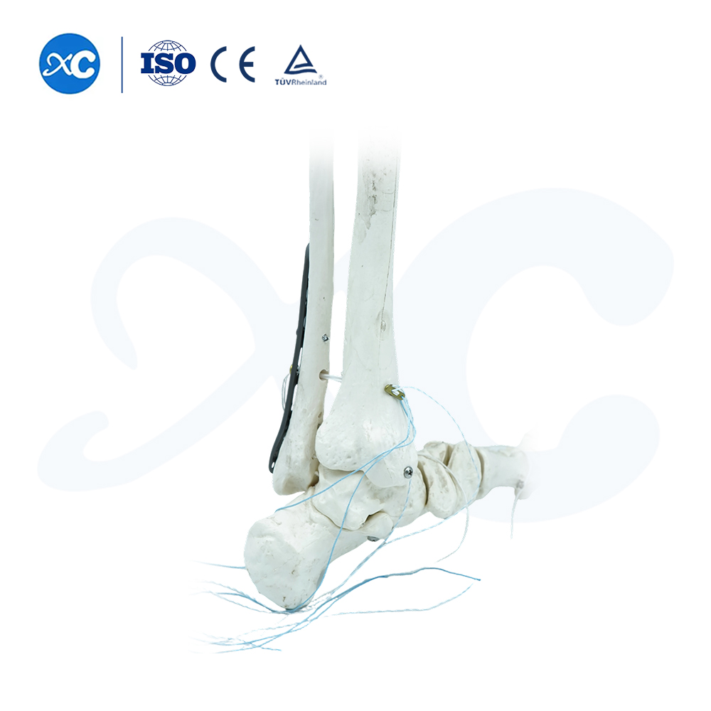 Pl&aacute;ta Glas&aacute;la Tibiofibular Distal-III - Ceannaigh T&aacute;irge ar XC Medico
