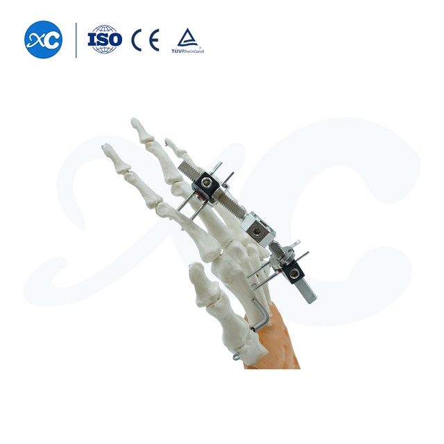 Mini Fixator Joint Motion Typ