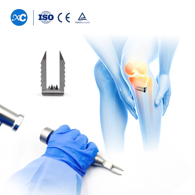 Ligament Staple we yu de yuz | Soft Tissue Fixation fɔ ACL Rikɔnstrɔkshɔn | XC Medico Spɔt Mɛdisin