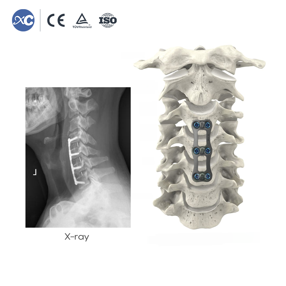 Sistema de placa cervical anterior | Implante de columna vertebral de titanio | XC Medico