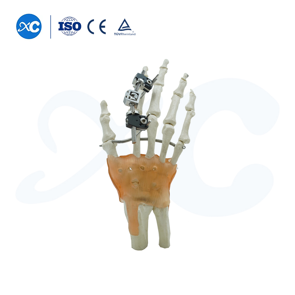 Mini Extern Fixator fir Metacarpal & Phalange Frakturen | XC Medico -3