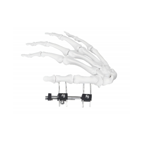 किन कोर्टिकल बटन फिक्सेसन सधैं उपचार मा महत्त्वपूर्ण छ