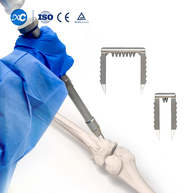 Ligament Staple we yu de yuz | Soft Tissue Fixation fɔ ACL Rikɔnstrɔkshɔn | XC Medico Spɔt Mɛdisin
