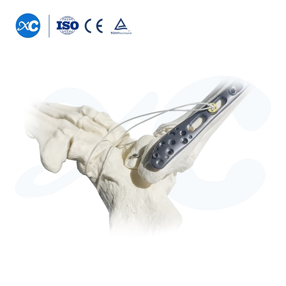 Pl&aacute;ta Glas&aacute;la Tibiofibular Distal-III - Ceannaigh T&aacute;irge ar XC Medico