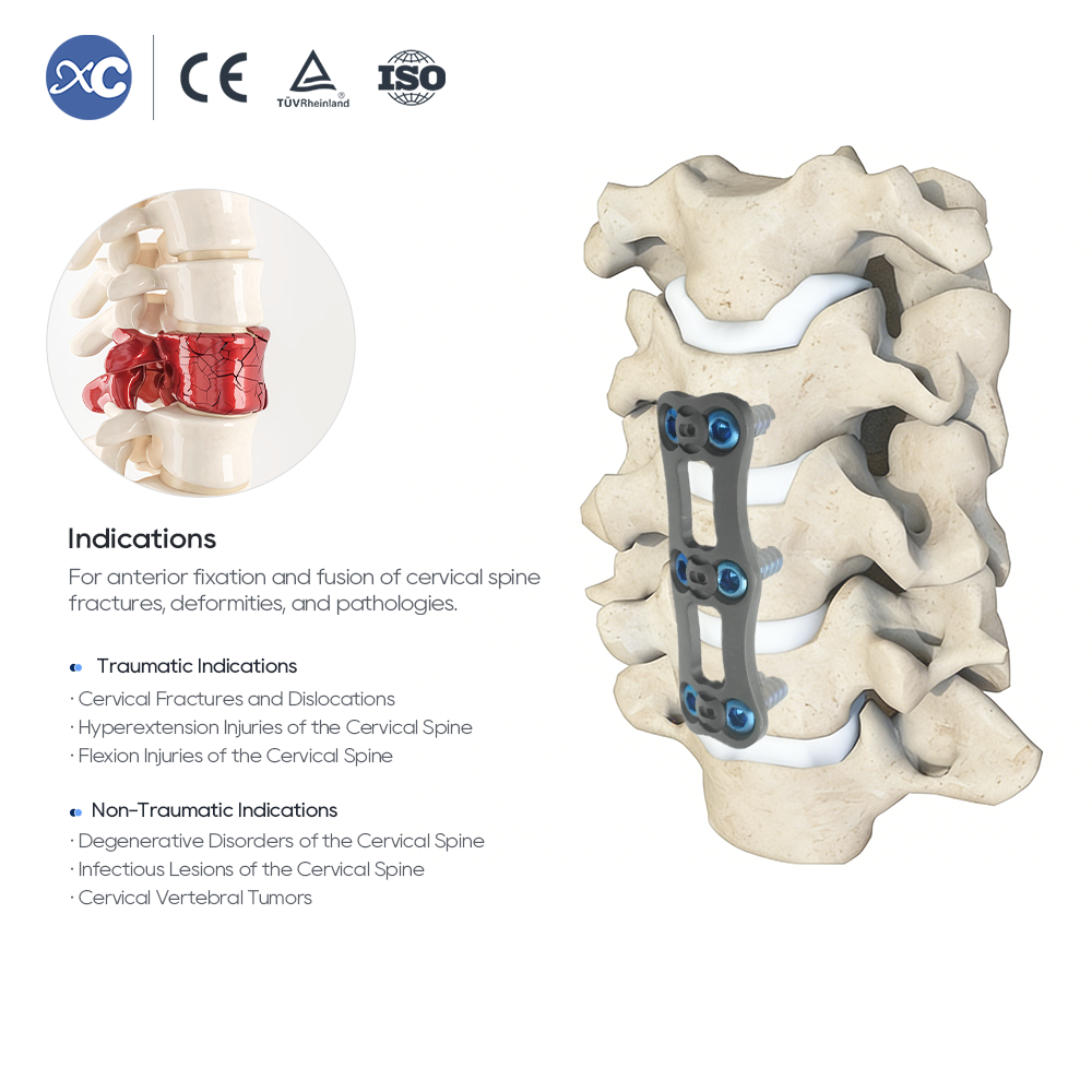Sistema de placa cervical anterior | Implante de columna vertebral de titanio | XC Medico