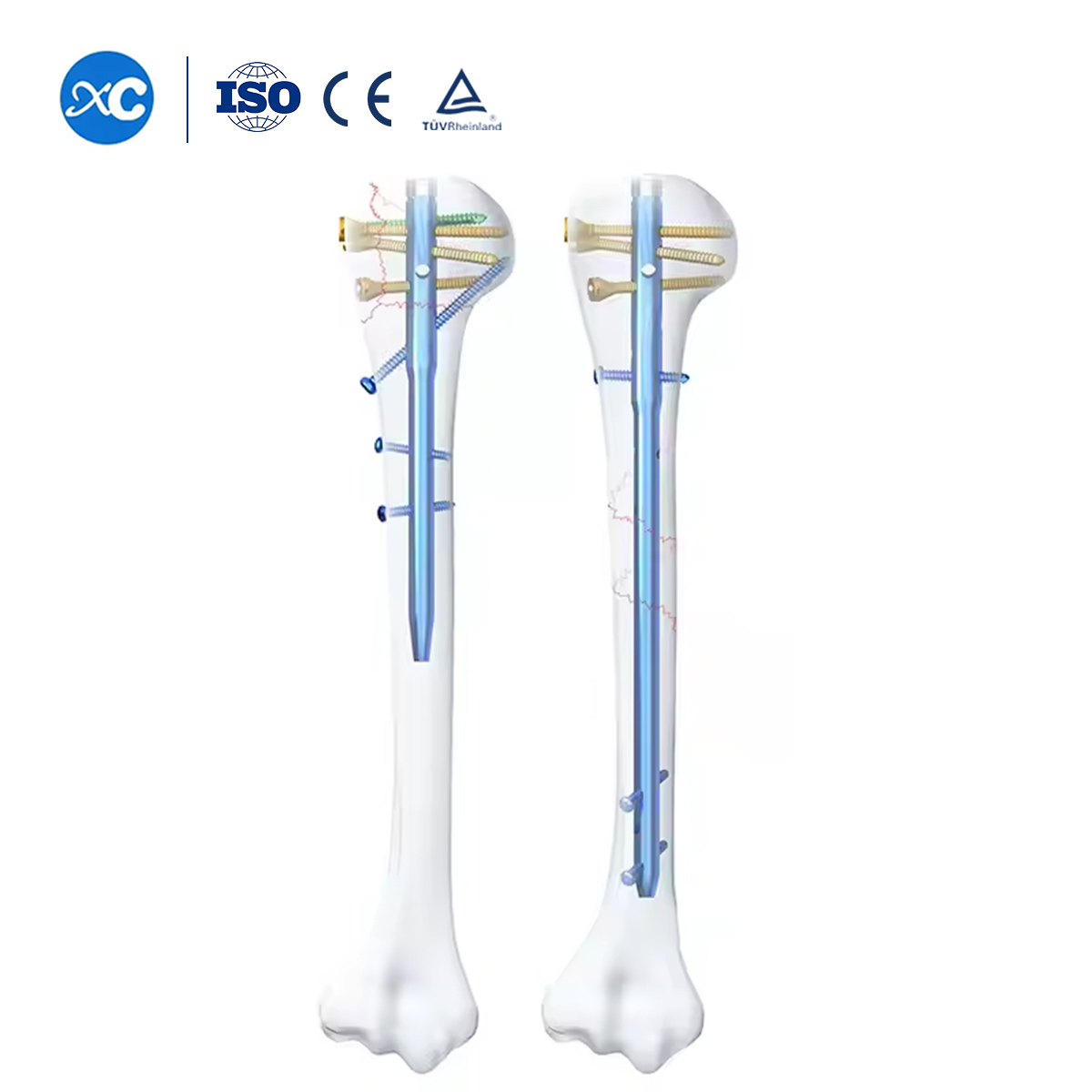 Humerus multi кулпу intramedularary mails