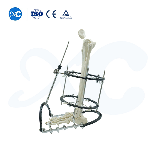 Pelvic & ankle fixator ext&eacute;rieur - san produit de XC m&eacute;dico .