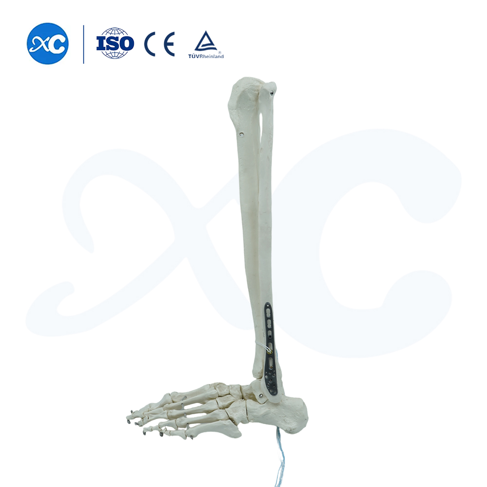 Pl&aacute;ta Glas&aacute;la Tibiofibular Distal-III - Ceannaigh T&aacute;irge ar XC Medico