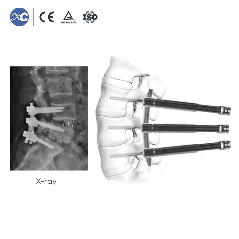 MisFix 5.5-System | Minimalinvasive Pedikelschraube | XC Medico