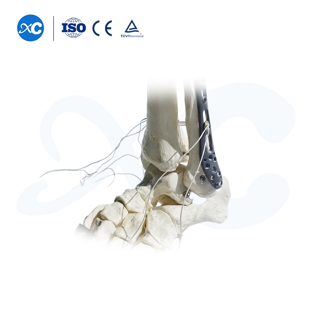 Pl&aacute;ta Glas&aacute;la Tibiofibular Distal-III - Ceannaigh T&aacute;irge ar XC Medico