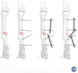 د پښې او زنګون پراخه کولو لپاره بهرنی فکسونکی Ex فکس