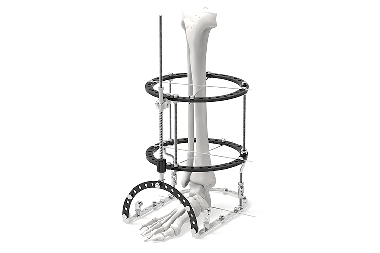 Pembetul Luar Pekeliling Ilizarov