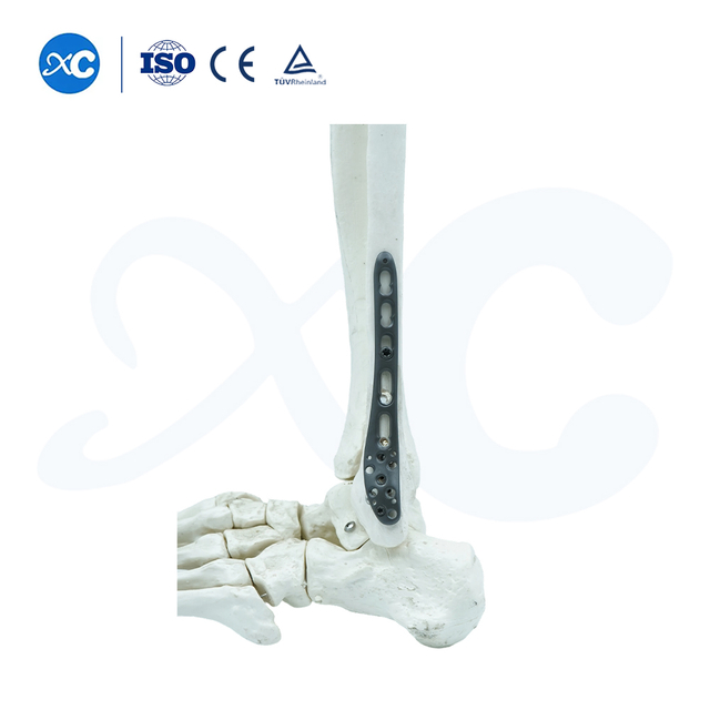 Distal Tibiofibuler Ngonci Plate-I - Beuli Produk on XC Medico