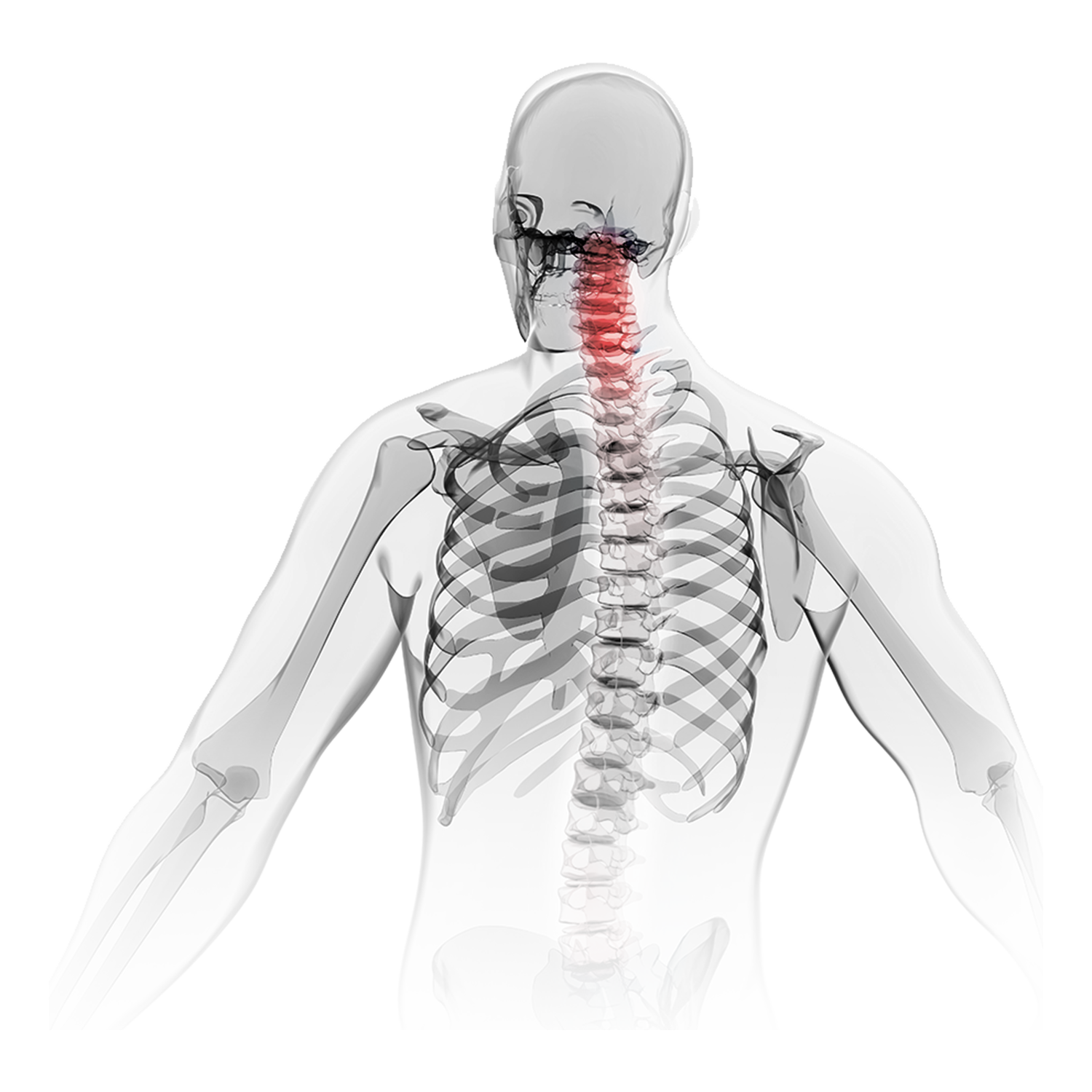 ACDF anterior cervical spine surgical solution