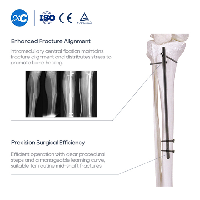 Xipikiri xa Tibial Intramedullary | Ku Tiyisisa Ku Pfuxetiwa Ka Tibia | XC Medico ya Vutshunguri