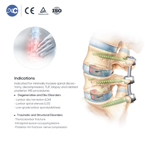 MIS Spinal Portal Dɔwɔnu Set - Ƒle Adzɔnu le XC Medico