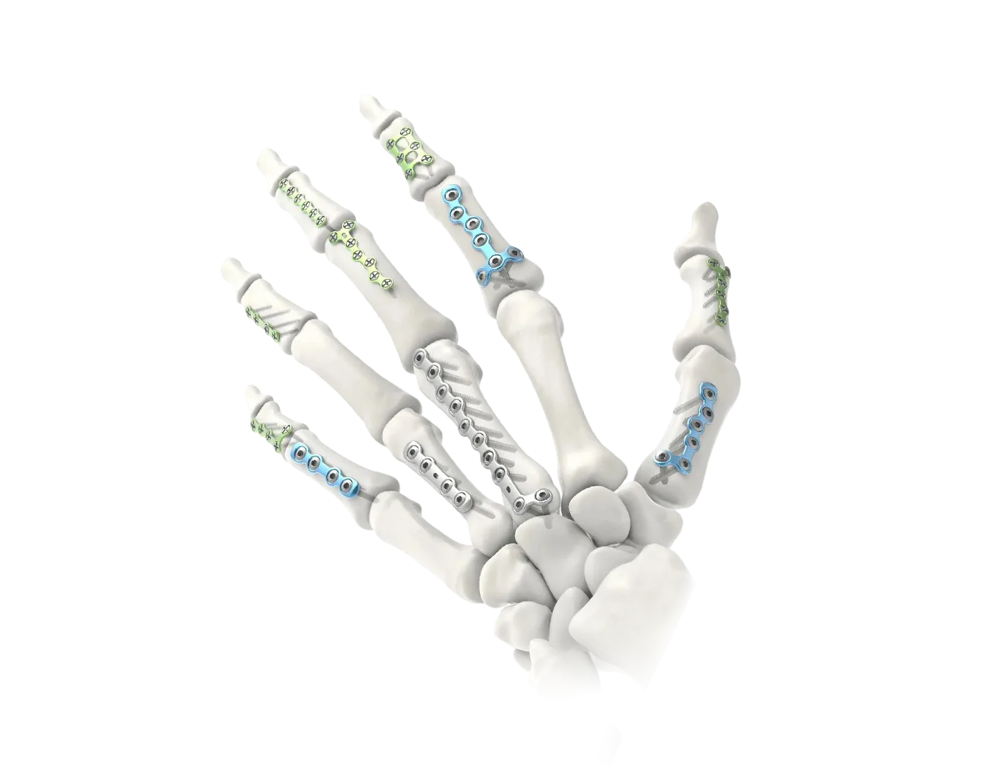 Hand skeleton and mini plate fixation portfolio