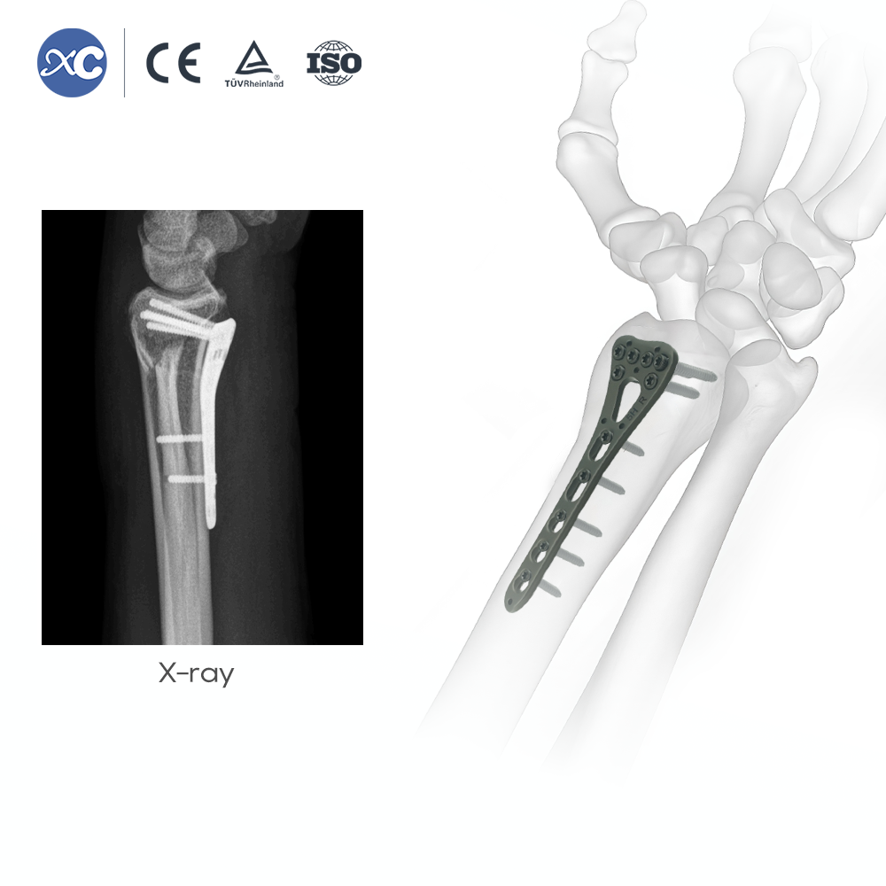 ʻO ka hoʻonohonoho ʻana i nā mea kani ʻo Distal Radius - XC Medico