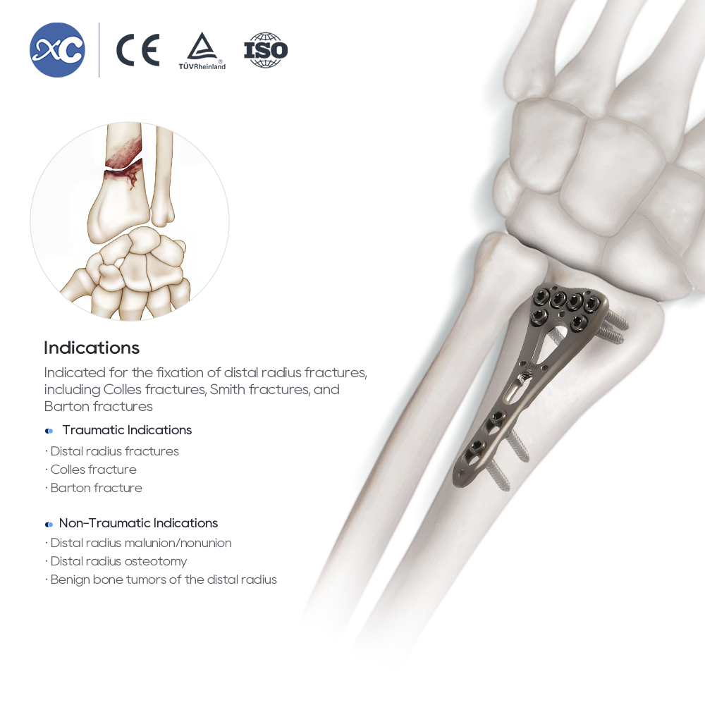 ʻO ka hoʻonohonoho ʻana i nā mea kani ʻo Distal Radius - XC Medico