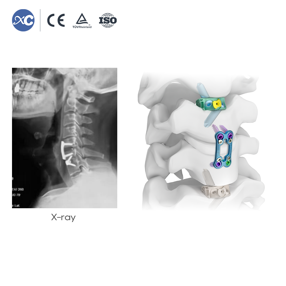 مجموعه ابزار جمع کننده گردن | جراحی ACDF | XC Medico