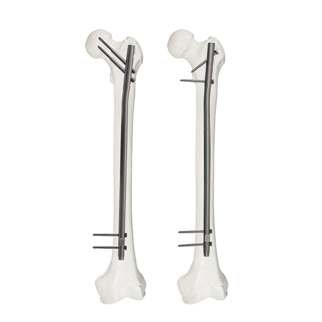 Femoral Reconstruction Intramedullary Nail for Femoral Fracture Fixation | এক্সসি মেডিকো