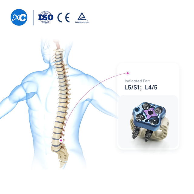 ALIF Cage & ATLPS Plate System - Anterior Lumbar Interbody Fusion Implantat