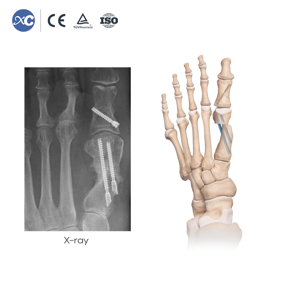 MIS Hallux Valgus वाद्ययंत्र सेट | कारखाना प्रत्यक्ष | XC मेडिको