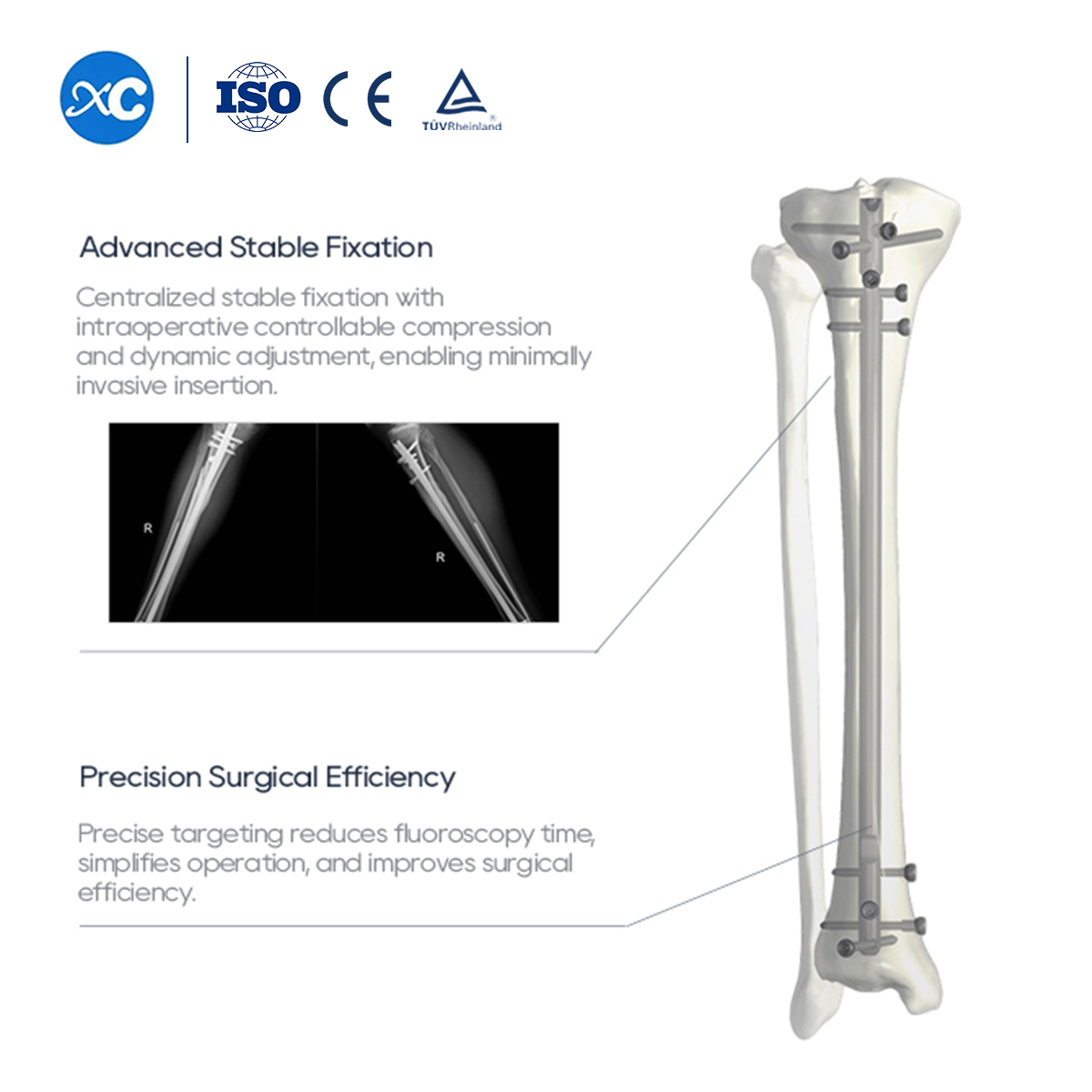 Nou conjunt d'instruments d'ungles intramedul&middot;lars tibials | XC Medic
