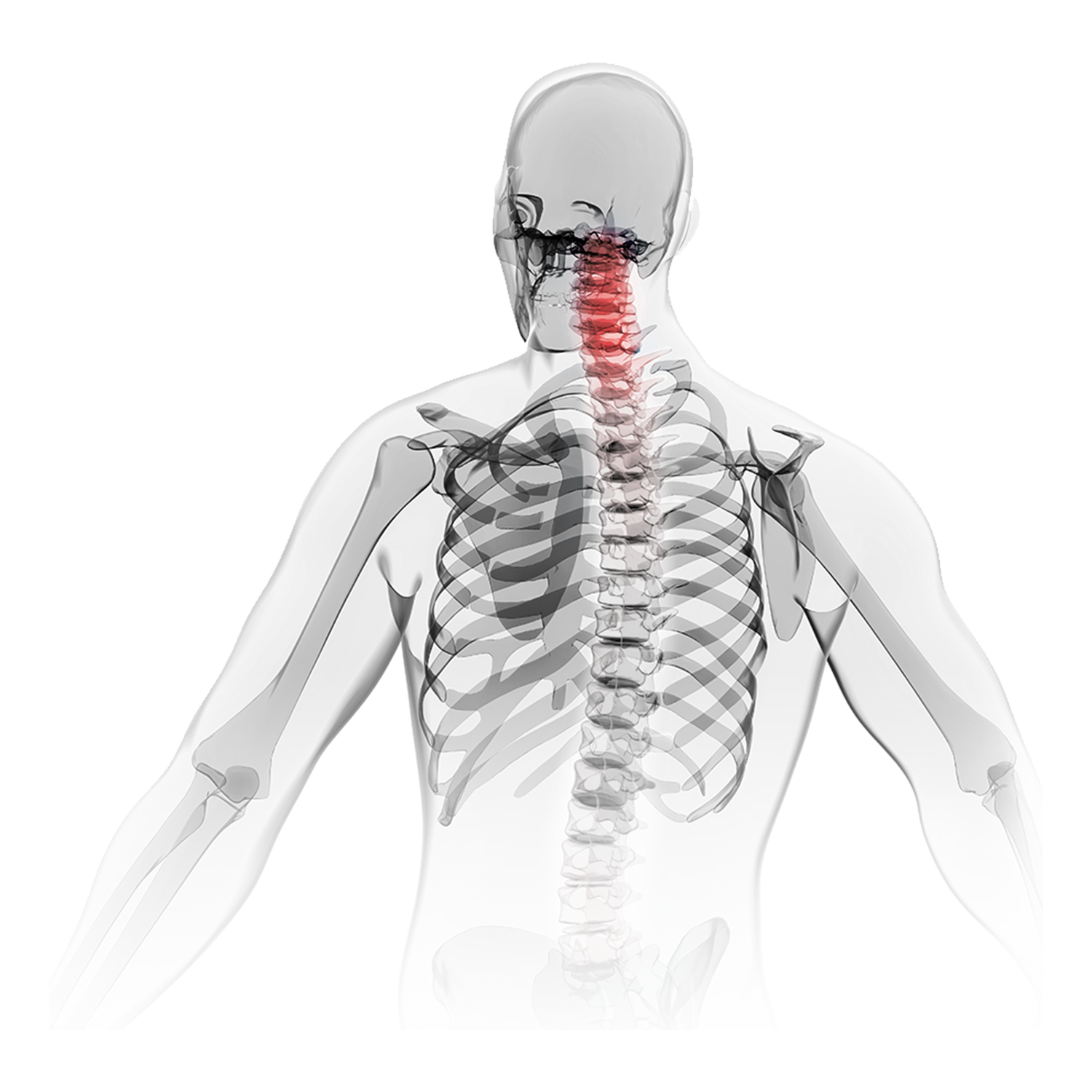 ACCF anterior cervical corpectomy and fusion solution
