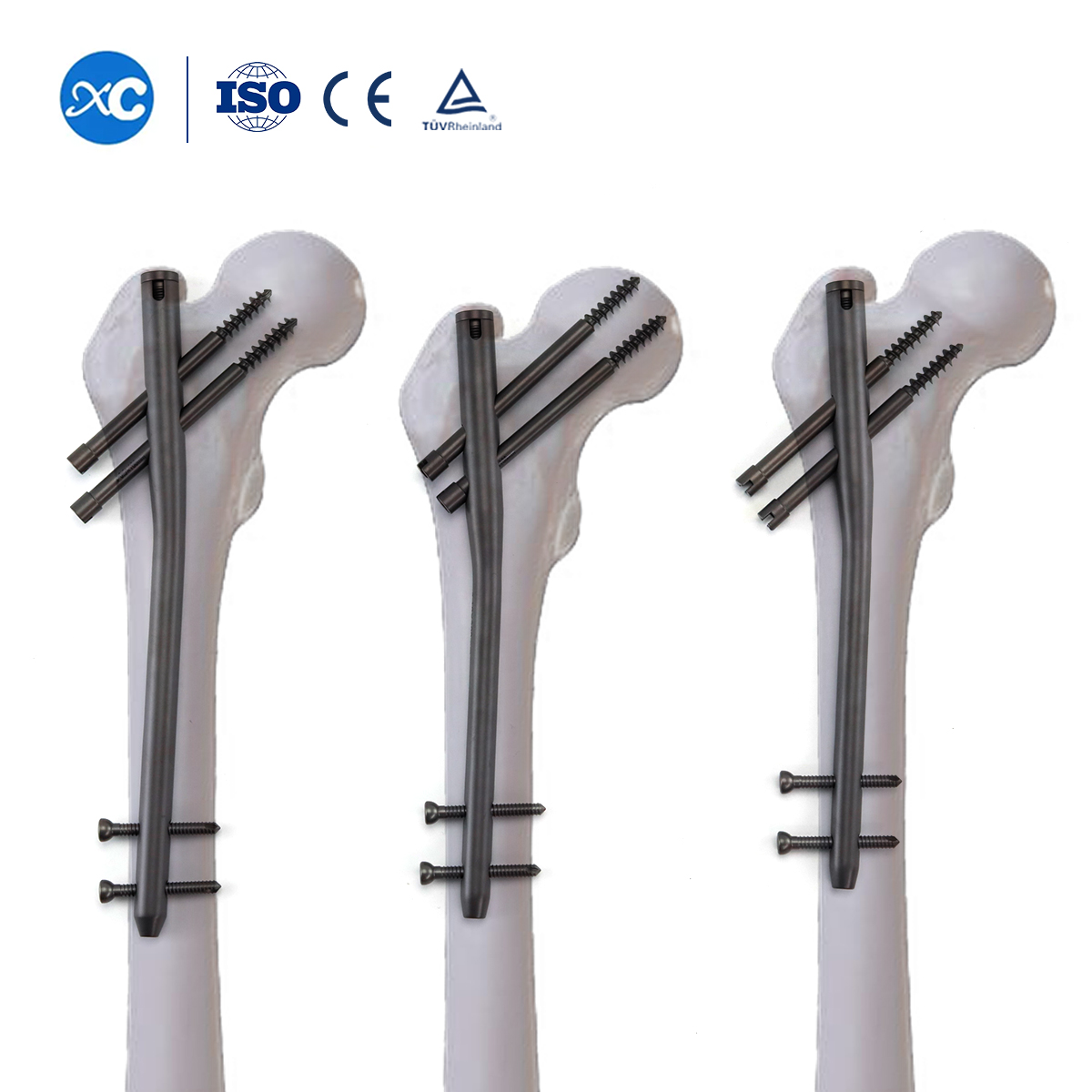 Titanium Gamma Nail | Proximal Femoral Fracture Fixation Implants