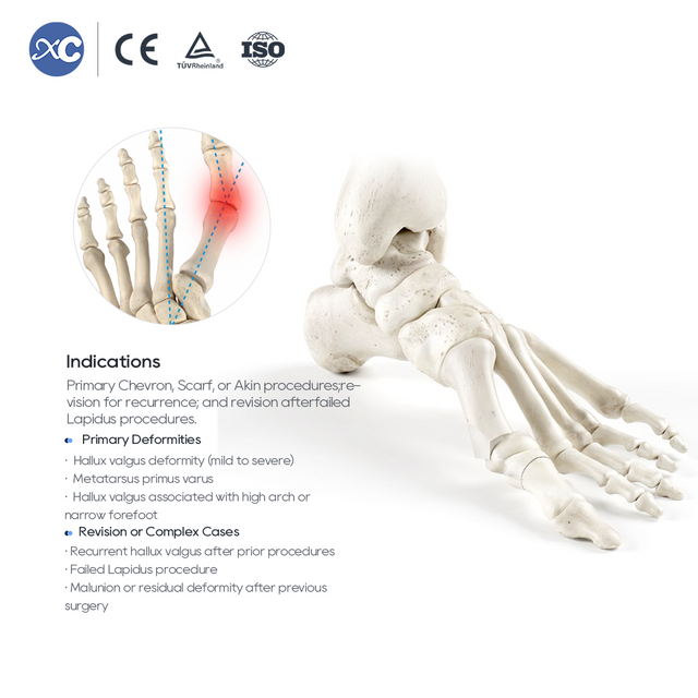 MIS Hallux Valgus Instrumɛnt Sɛt | Faktɔri Dairekt | XC Mɛdiko