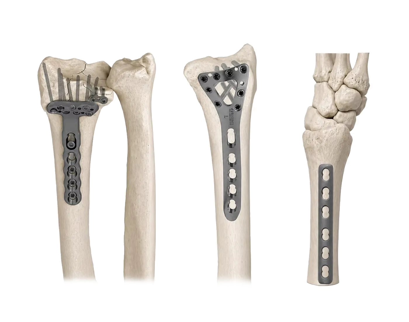 Distal radius plate fixation portfolio